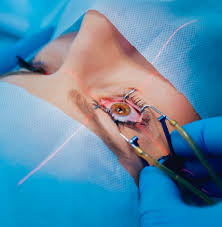 Cataract Surgery Support